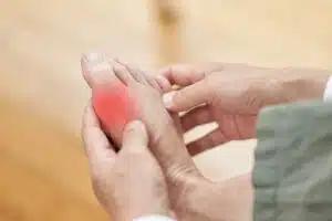 va disability rating for gout