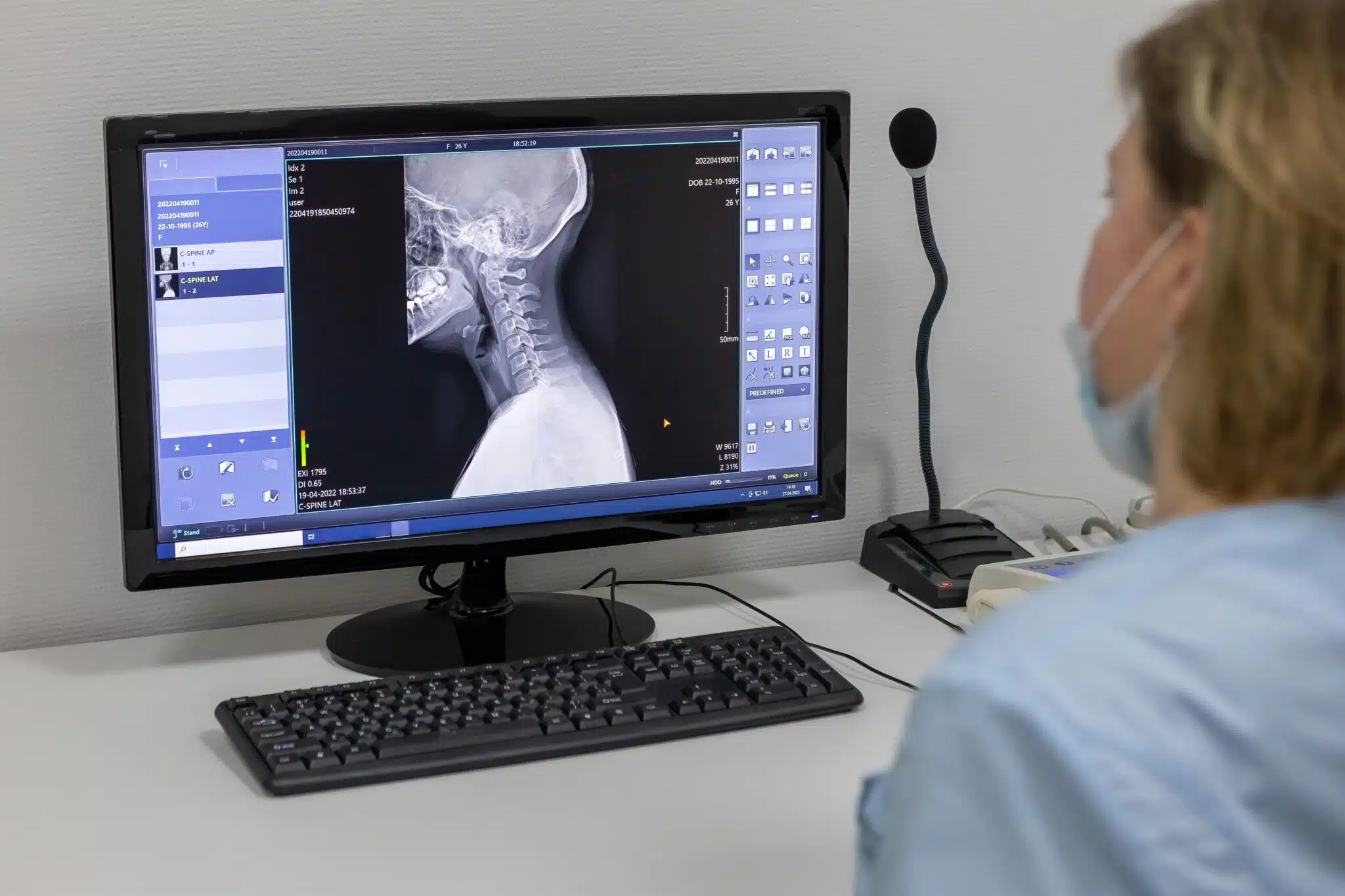 va rating for cervical radiculopathy