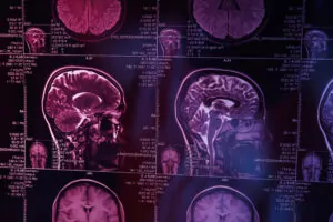 Traumatic Brain Injury and Veterans Disability