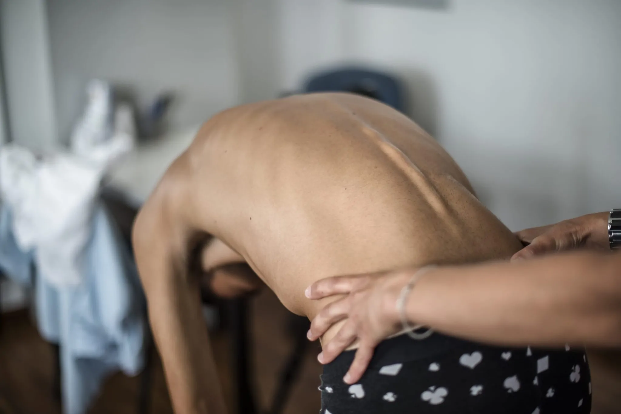 Scoliosis and Veterans Disability