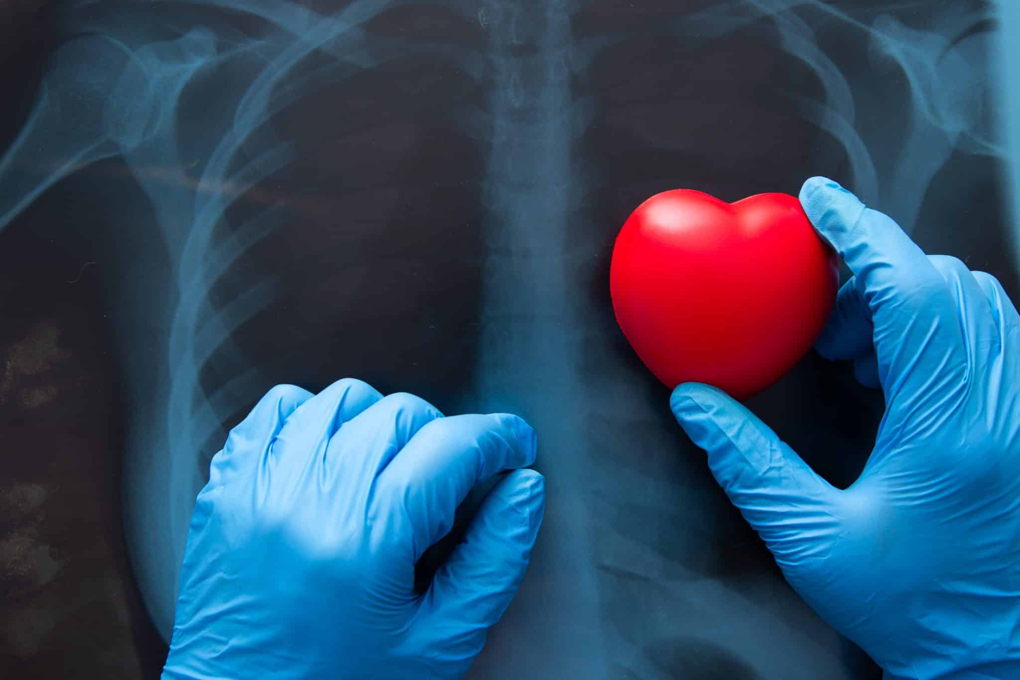 VA METs Test Results Explained for Cardiac Disability Claims